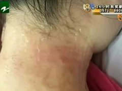 代妈拔火罐闻到烤肉味竟是自己的